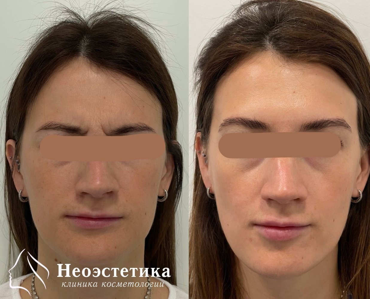 Ботулинотерапия в клинике НеоЭстетика
